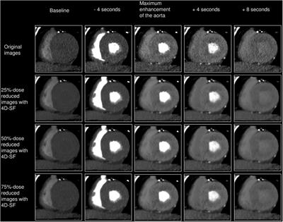 Feasibility of four-dimensional similarity filter for radiation dose reduction in dynamic myocardial computed tomography perfusion imaging